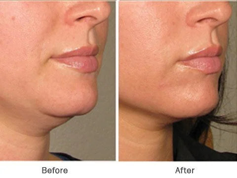 Lumi Lift Pro Facial Massager
