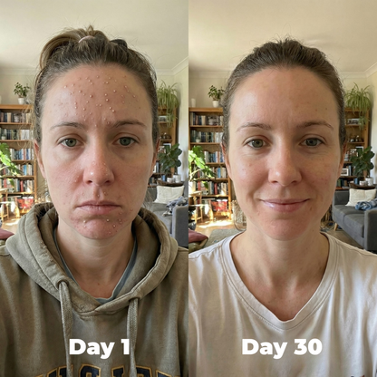 Acne Buster Lotion