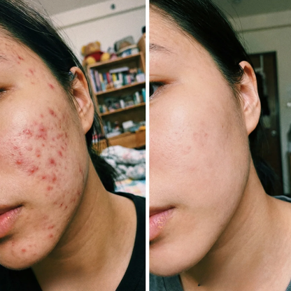 Acne Buster Lotion