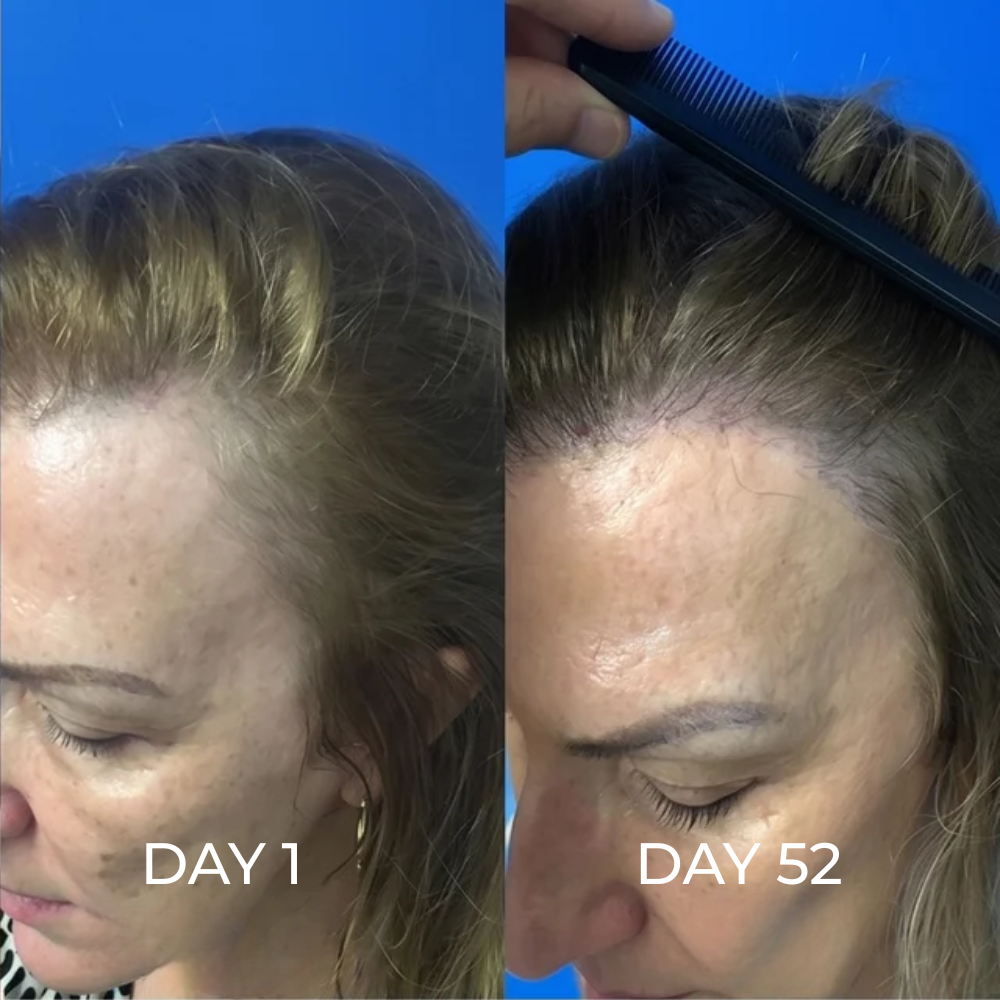 ReGene -Hair Growth Cap