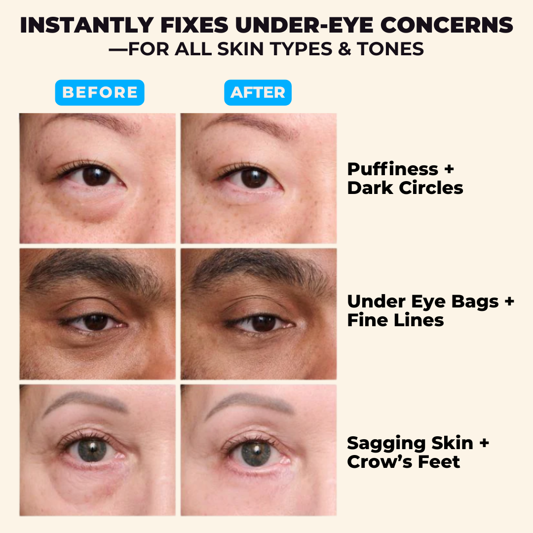 Eye Tightener