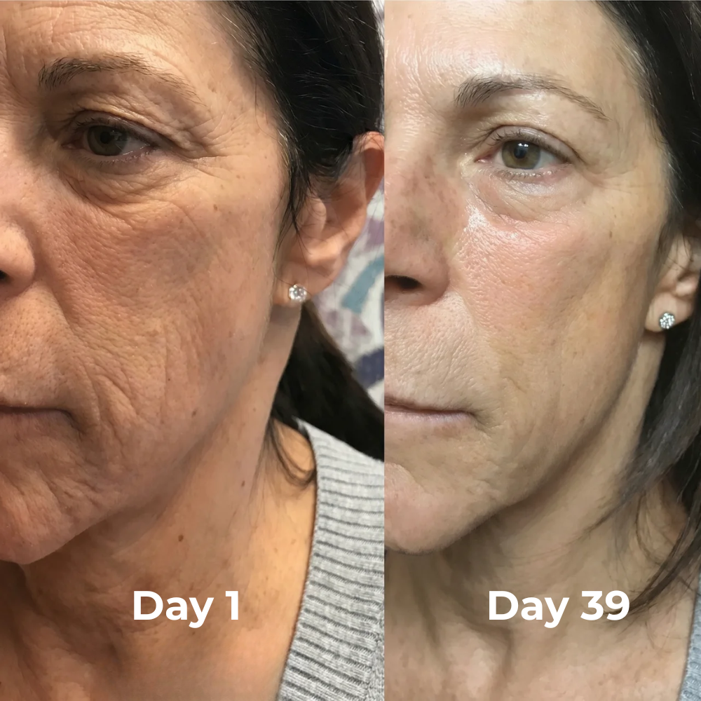 V-Sculpt™ Facial Lifting Device