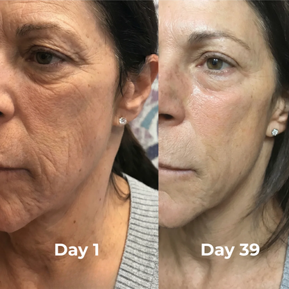 V-Sculpt™ Facial Lifting Device