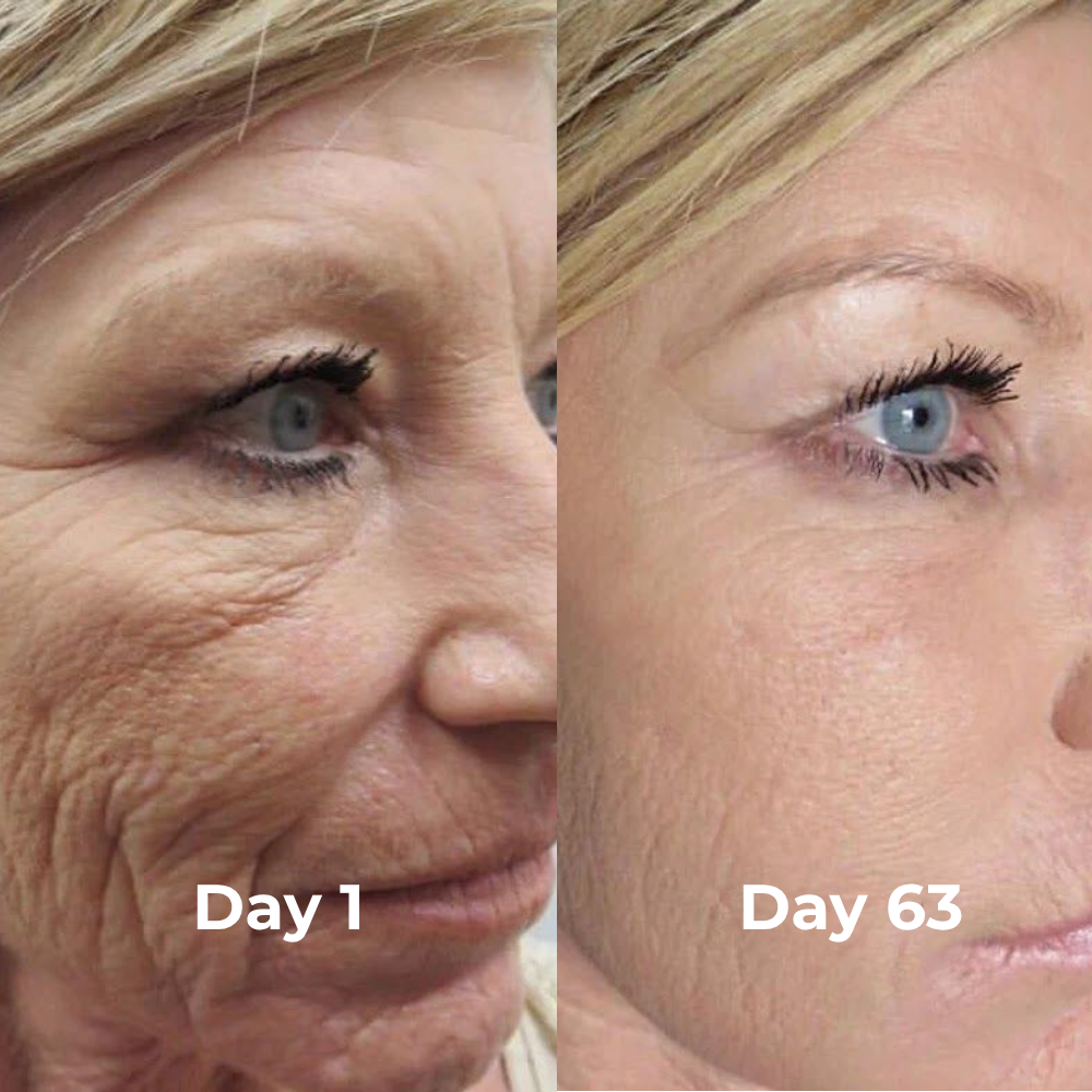 V-Sculpt™ Facial Lifting Device