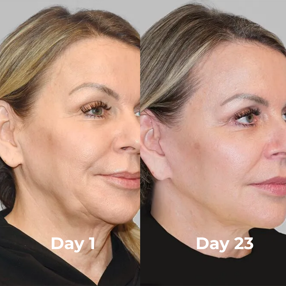 V-Sculpt™ Facial Lifting Device