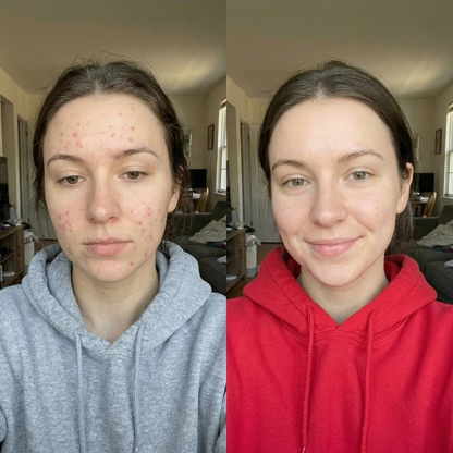MicroLift Pro