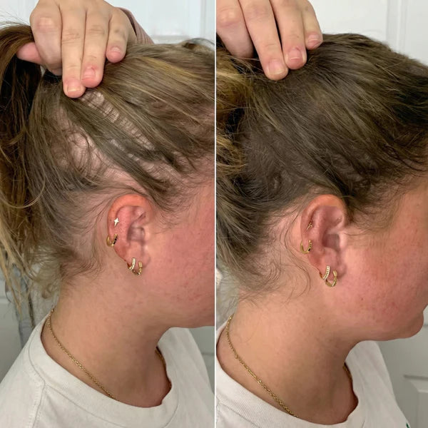 RegenScalp™ Hair Care Device