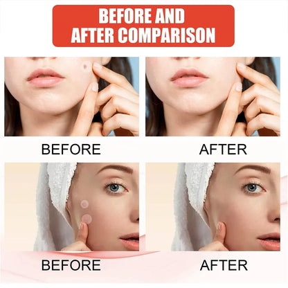 Pimple Acne Patches