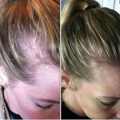 RegenScalp™ Hair Care Device
