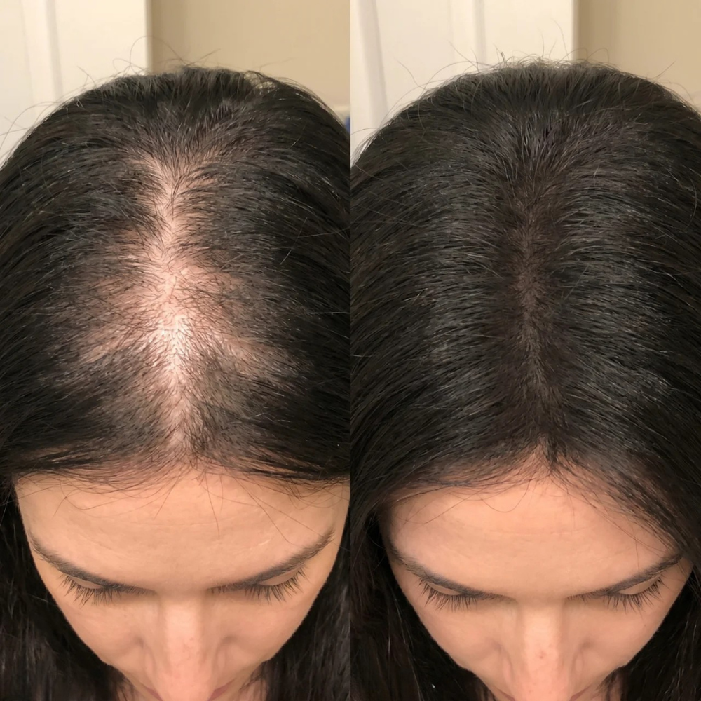 Hair Regrowth Comb