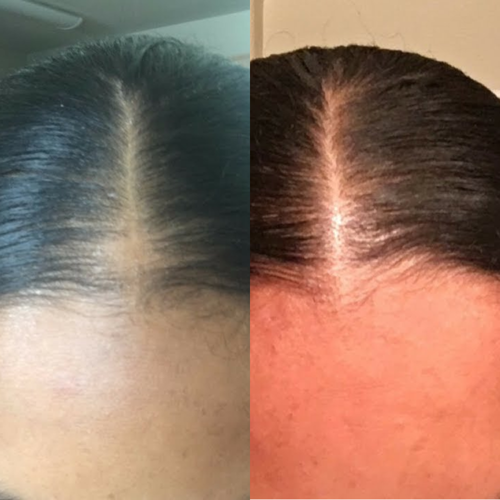 Hair Regrowth Comb