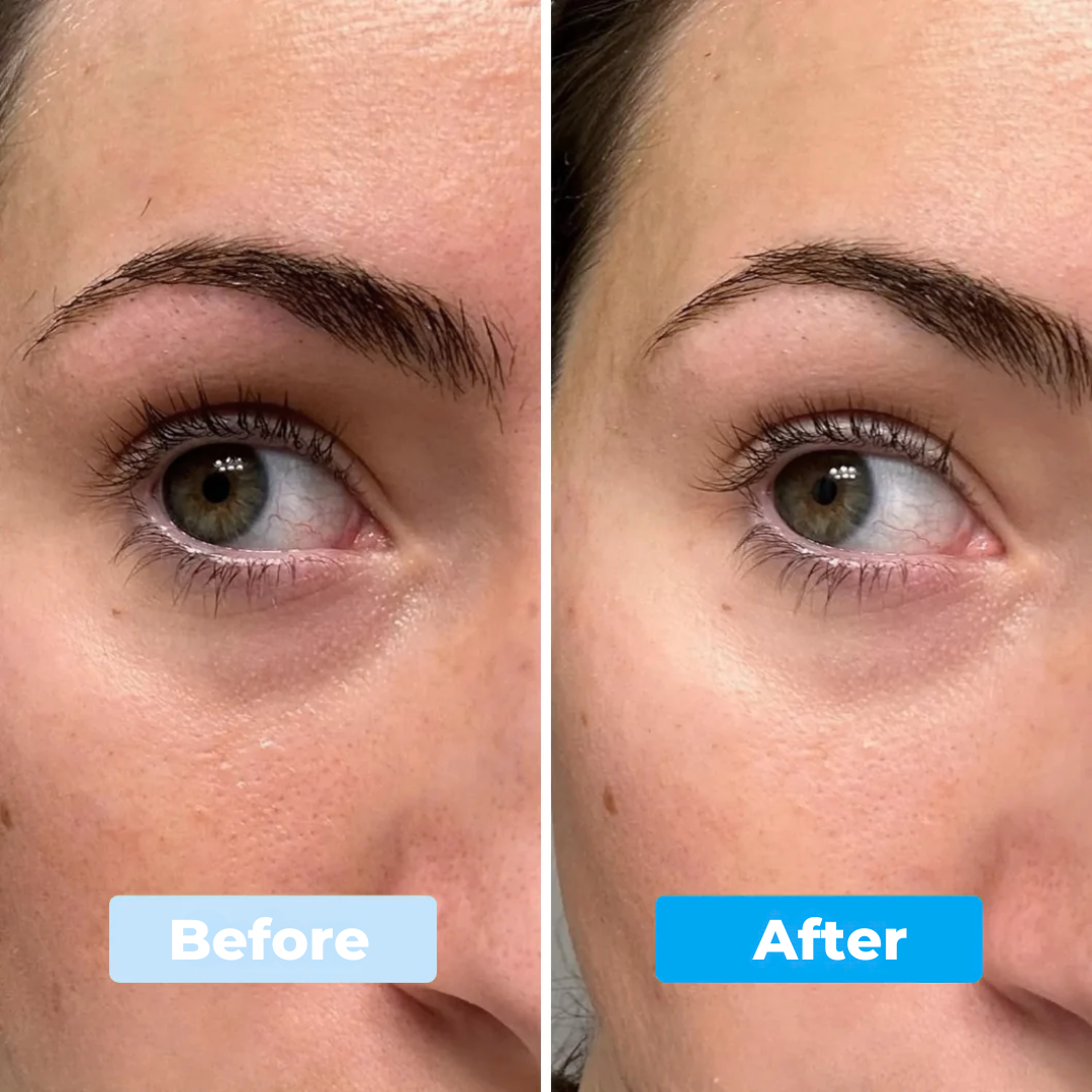 Avocado Eye Patches