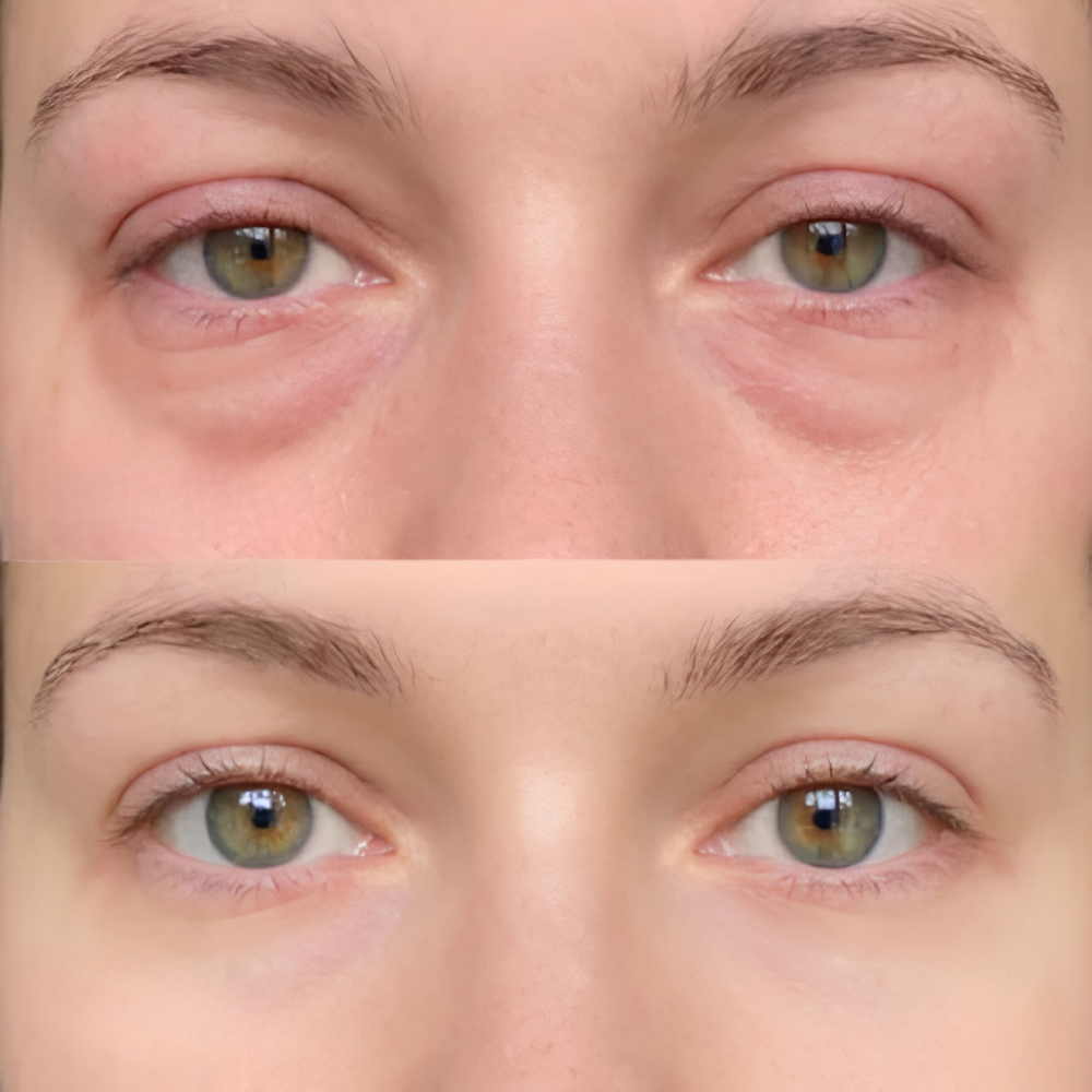 Reedle Shot Eye Lifting Cream