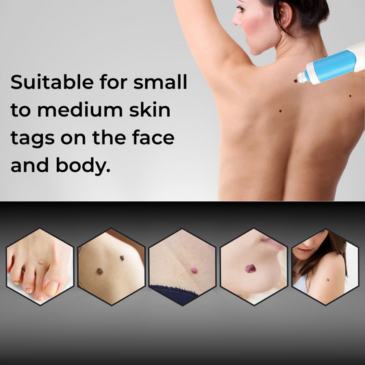 Auto Skin Tag Removal Kit