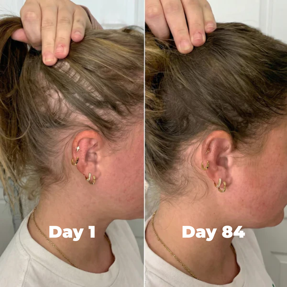 Postpartum Hair Growth Gummies