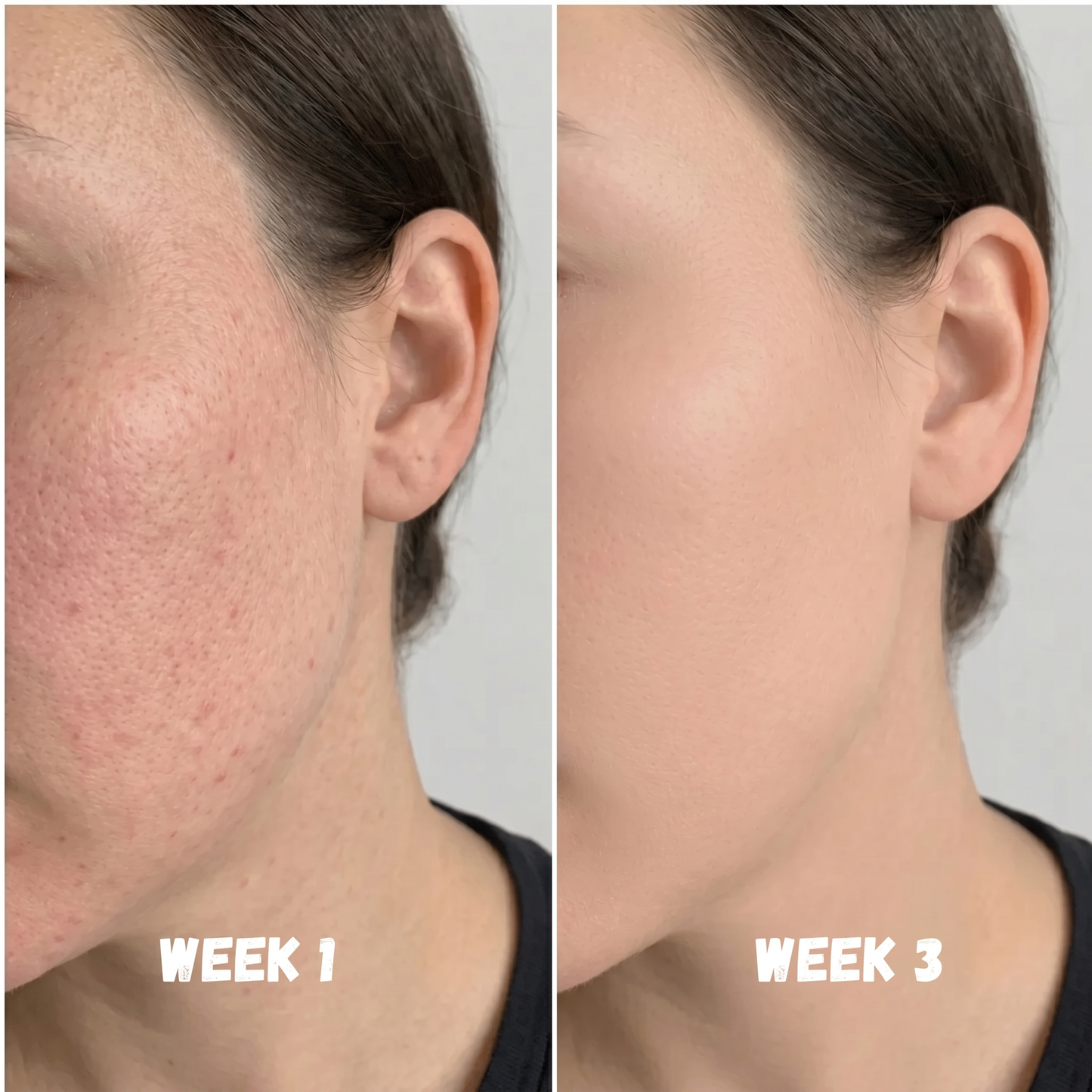 Derma Peel Exfoliator